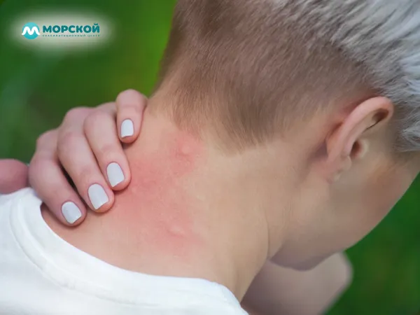 Покраснение на шее Аллергия на шее